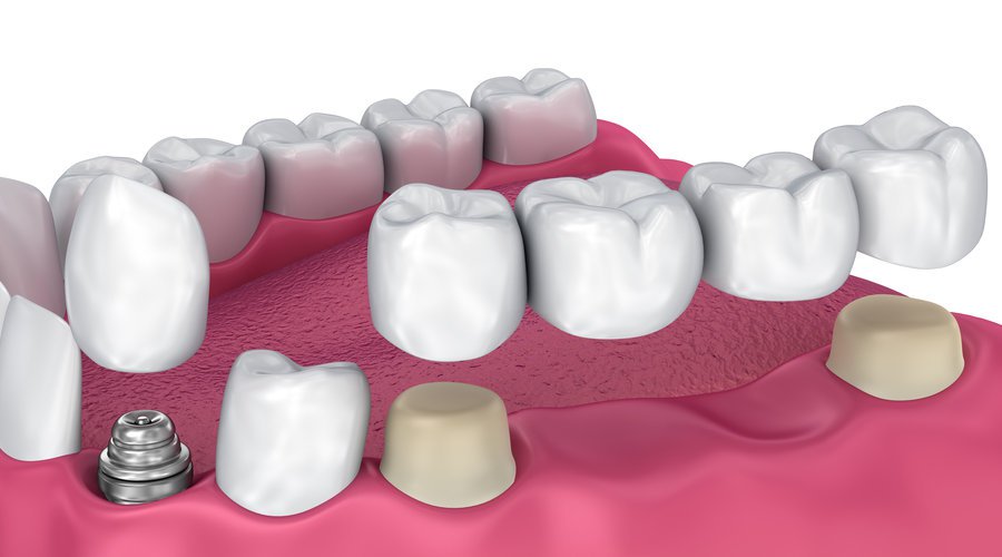 Implantes dentales Santo Domingo